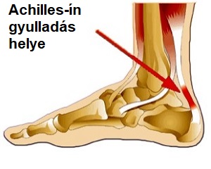 Achilles-ín gyulladása